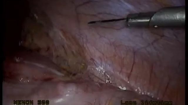 Киста надпочечника смотреть онлайн