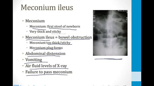 Лёгкие USMLE - 3. Иные темы - 5.Муковисцидоз (МВ)