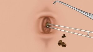 ASMR 10년 묵은 배꼽 때 제거 애니메이션‼️ 10 year old navel stone removal animation