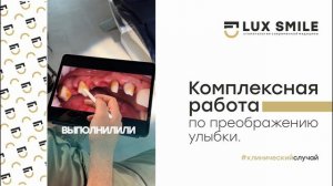 Клинический случай. Эстетическая стоматология. Виниры. Люкс Смайл.