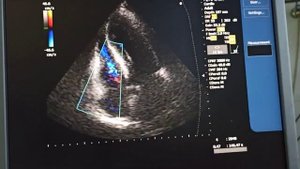 Дефект межжелудочковой перегородки