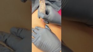 Растяжки на ногах