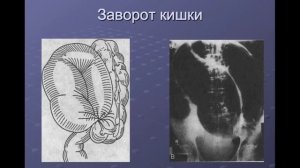 Лекция для дистанционного обучения студентов на тему: "Острая кишечная непроходимость"