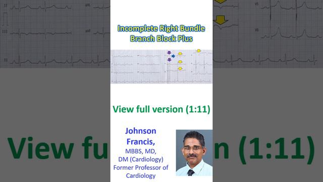 Incomplete Right Bundle Branch Block Plus!