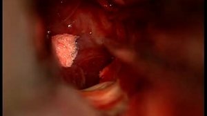 Транскаллезное удаление аденомы гипофиза 1