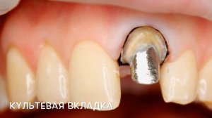 Металлокерамическая коронка , стоматология , препарирование зубов, вкладка.