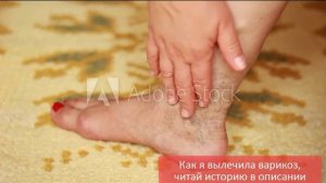Как лечить варикоз в домашних условиях, 10 видео рецептов