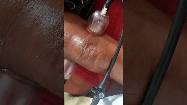 knee pain cupping treatments ?