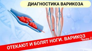 ОТЕКАЮТ И БОЛЯТ НОГИ. Диагностика варикоза (Часть 2)