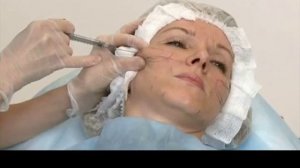 Контурная пластика лица  Гиалуроновая кислота