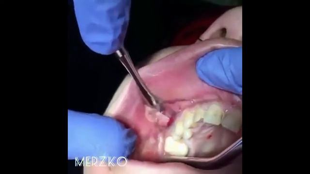 УДАЛЕНИЕ ГНОЯ С ПОЛОСТИ РТА. (18+) смотреть онлайн