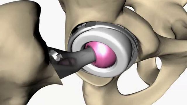 Тазобедренные протезы двойной мобильности смотреть онлайн