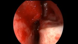 Грибок в гайморовой пазухе. Эндоскопическое удаление