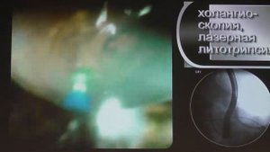 05 Бахтиозина ДВ Эндоскопическая диагностика и лечение сложного рецидивного холедохолитиаза