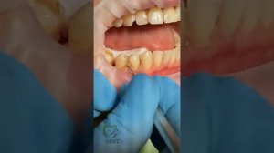 Лечение клиновидного дефекта! Ждём вас на БЕСПЛАТНУЮ КОНСУЛЬТАЦИЮ в стоматологию R.A.Dent