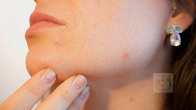 Намазала свою дочь этой маской от черных точек! Через неделю лицо чистое без прыщей и угрей! смотреть онлайн