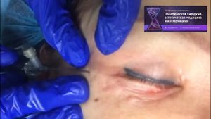 КОРРЕКЦИЯ РУБЦОВ ПОСЛЕ БЛЕФАРОПЛАСТИКИ