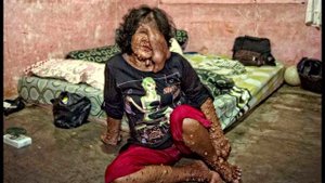 САМЫЕ РЕДКИЕ И МУЧИТЕЛЬНЫЕ БОЛЕЗНИ #2