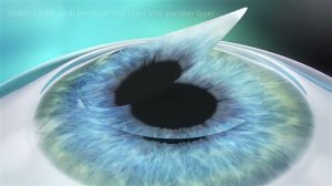 Коррекция зрения Femto LASIK наглядно