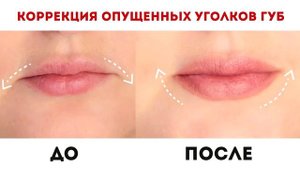 Увеличение губ гиалуроновой кислотой