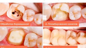Как выглядит кариес: фото зубов, пришеечный, глубокий, кариес у детей и взрослых