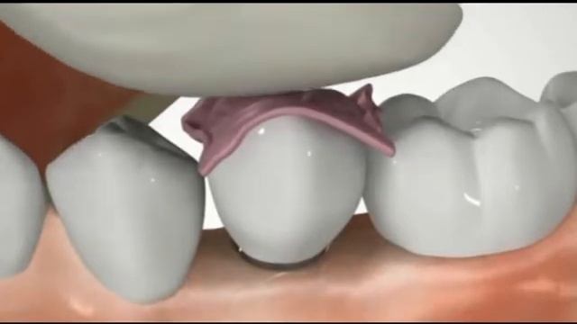 Протезирование в стоматологии Петра смотреть онлайн