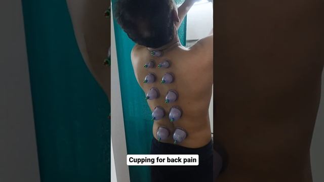 cupping for back pain