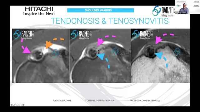 MRI Online Review Learn MSK MRI Radiology : MRI Shoulder MRI Biceps Tendonosis and Tenosynovitis