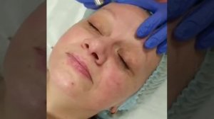 Алмазный пилинг, микродермабразия, очищение и омоложение лица, проблемная кожа