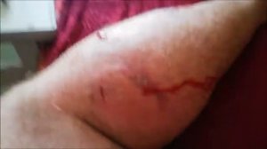 Укусила собака. Рана от укуса собаки. Кровь, Синяк.  Киев. 26.08.2019 г.