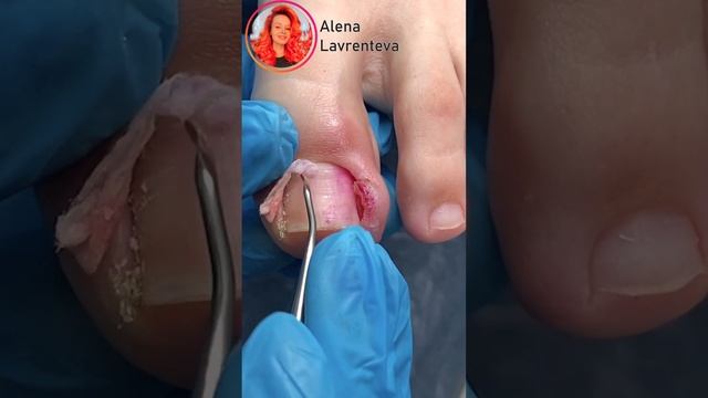 Удаление Вросшего ногтя / Врос ноготь на ноге что делать? #nails #shortsvideo #shorts