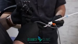 удаление полипа во время колоноскопии