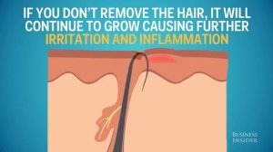 Прыщи, одна из причин их появления!