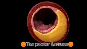 Как отрывается тромб I Кровоизлияние  I Лопнул варикоз