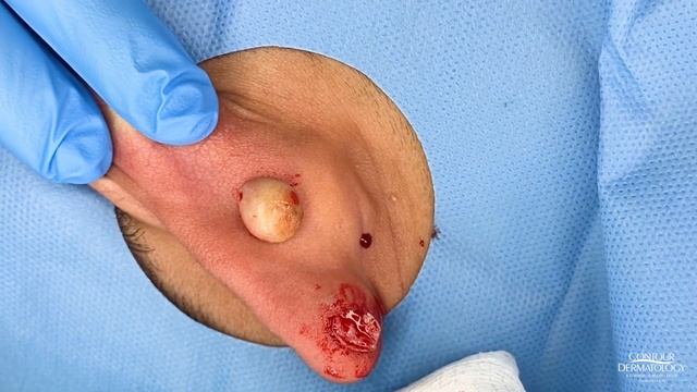 Keloid Scar Removal | Contour Dermatology смотреть онлайн