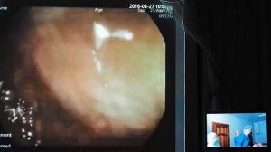 40 Live03 Королевский ЕС   Колоноскопия при НЯК  Подготовка Пикопреп