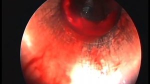 Инородное тело верхнечелюстной (гайморовой) пазухи - имплантат