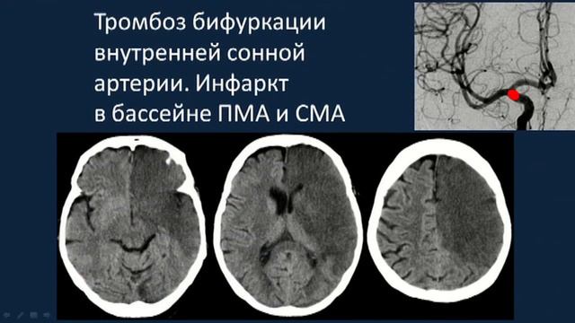 Нейровизуализация при инсульте
