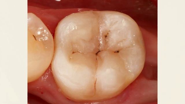 КАК ВОВРЕМЯ ОБНАРУЖИТЬ КАРИЕС .ПАМЯТКА ДЛЯ РОДИТЕЛЕЙ! смотреть онлайн