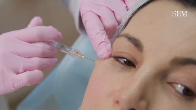 КОРРЕКЦИЯ ПЕРИОРБИТАЛЬНОЙ ЗОНЫ ПРЕПАРАТОМ RESTYLANE
