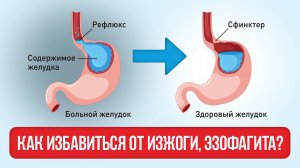 Эзофагит, ГЭРБ как и чем правильно лечить, а чем нельзя. Не работает клапан?