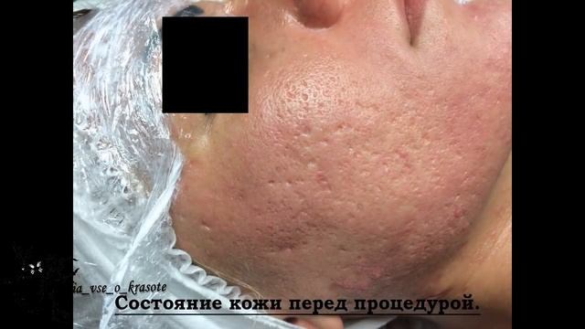 Лазерная шлифовка