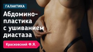 Абдоминопластика с ушиванием диастаза | Красковский Федор Янович