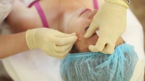 Нитевой лифтинг: мезонити и аптос. Омоложение кожи лица в клинике "Медисса", Крым.