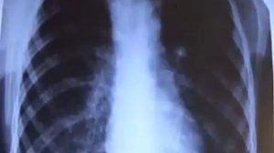 Туберкулез и его виды на флюорографических снимках