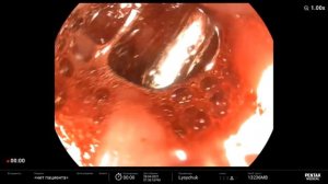 Mallory-Weiss syndrome. Endoscopic Treatment Bleeding. Forrest IB. С-м Мелори-Вейса, гемостаз