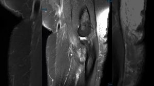 Biceps tendon and common extensor tendon tear of elbow