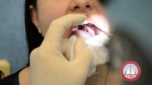 Непрямая ларингоскопия