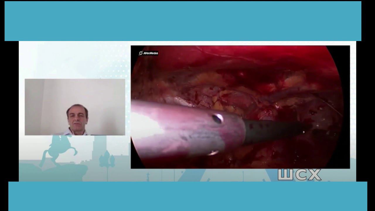 Laparoscopic eTEP inguinal hernia видеолекция полное видео смотреть онлайн