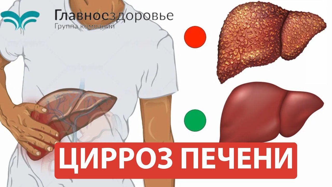 Цирроз печени. Экстренная помощь